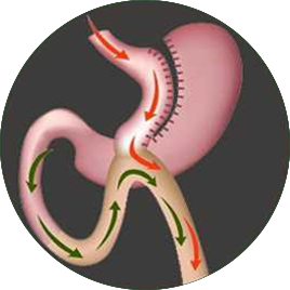 Laproscopic Gastric Bypass surgery 
